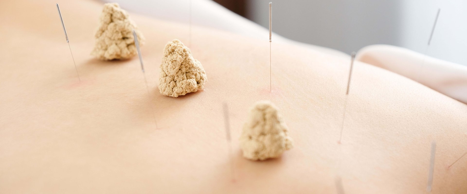 鍼灸治療・美容鍼灸